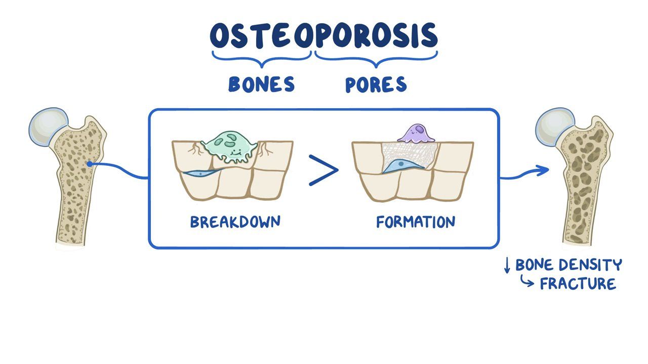 Osteoporosis